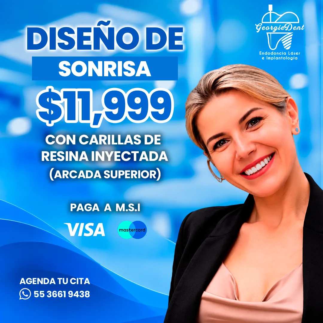 Promoción diseño de sonrisa con carillas de resina inyectada (arcada superior) por $11,999